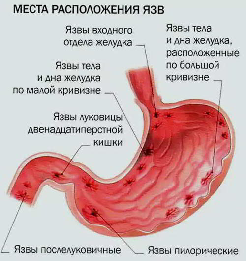 Язва желудка