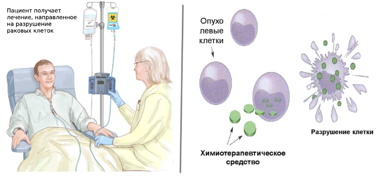 Лечение химиотерапией